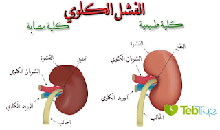 تجارب علاج الفشل الكلوي بمنتجات المكملات الغذائية لشركة dxn