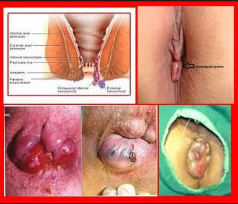 Cara Menyembuhkan Wasir External