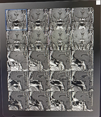 MRI Pituitary fossa