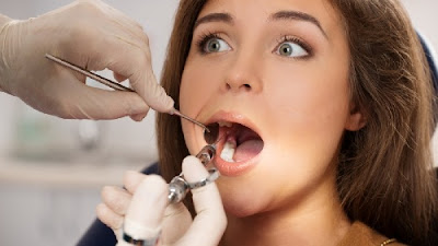 Trám răng mất bao lâu áp dụng cho răng cửa?-2