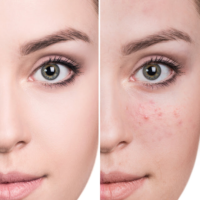Masque pour éliminer les boutons d'acné spécial peau sèche