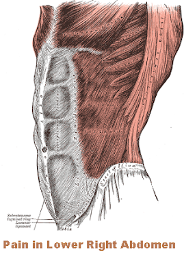 Pain in Lower Right Abdomen