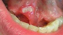 Úlceras en la boca - causas y tratamiento de ulceras bucales