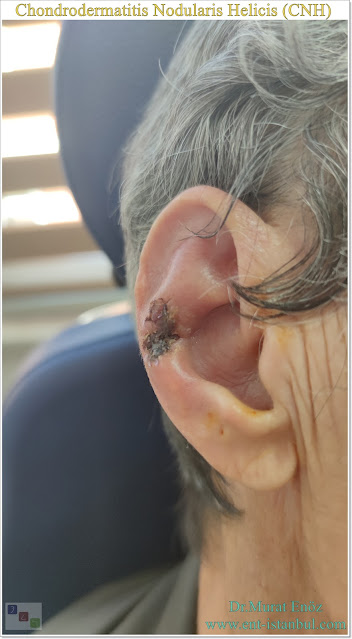 Chondrodermatitis Nodularis Helicis, CNH, Auricle lesion, Small tender nodule on the auricle