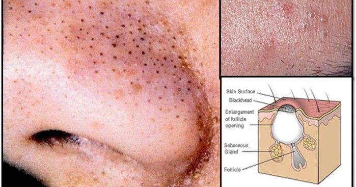 9 Cara Menghilangkan Komedo Hitam di Hidung dengan Cepat ...