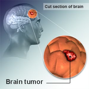 Dec According To A Study Led By University Of Massachusetts Healthcare School Researchers Outpatient Chemotherapy Draft Is Prone To Further 