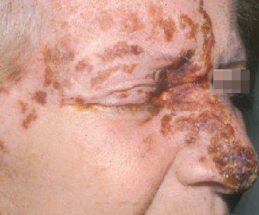 herpes zoster face. Herpes Zoster (shingles) is