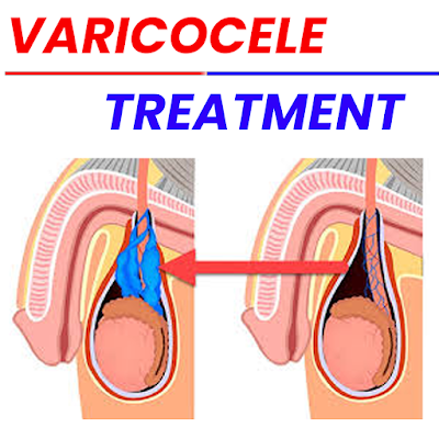 Varicocele Treatment_https://bharathomeopathy.com/diseases/varicocele-treatment