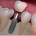 Lý do nên cấy ghép Implant cho người trung niên