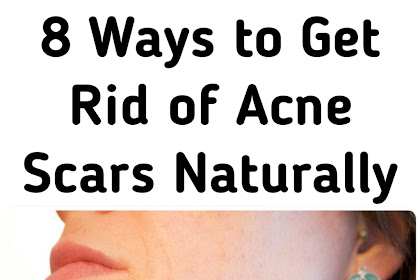 8 Ways to Get Rid of Acne Scars Naturally