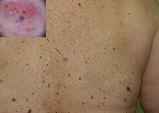 Skin Cancer Early Stages