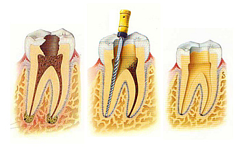 Endodoncia