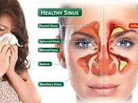 Atasi Sinusitis dengan Air Alkali