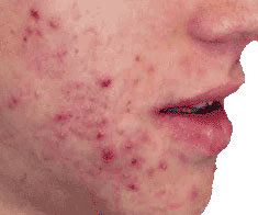 Hereditary Acne