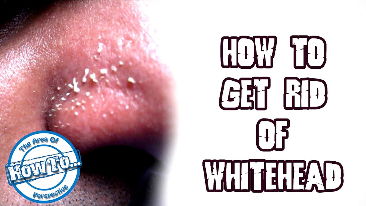 How To Get Rid Of White Heads On Face