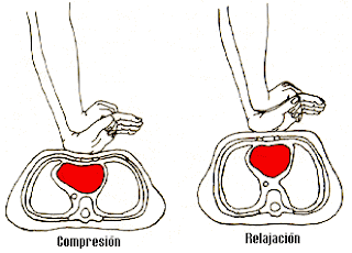 compresion cardiaca externa