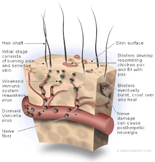 Fast Shingles Cure – The #1 Shingles Treatment Method Available