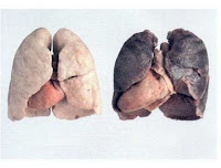 An Insight into the Different Types of Mesothelioma