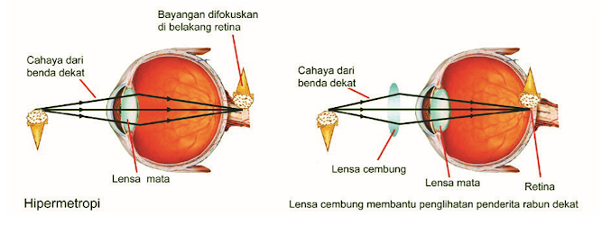 Gambar Perubahan Fokus Sinar pada Rabun Dekat