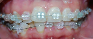 teeth-braces