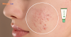5 Acne Creams Recommended by Dermatologists