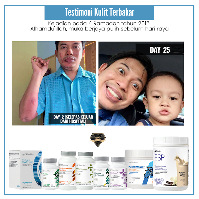 Pengalaman Kulit Melecur Terkena Api Kembali Pulih Dengan Supplement Shaklee