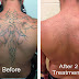  Effects of Laser tattoo removal on soft skin