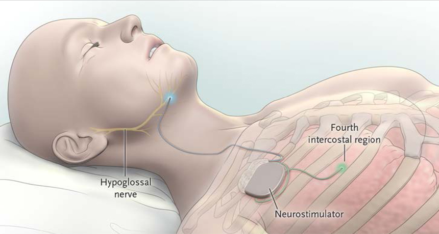 Leczenie OBS za pomocą stymulacji nerwu podjęzykowego (implant Inspire)