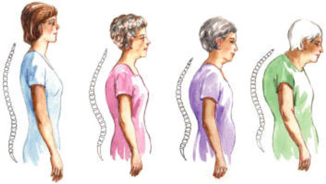 Kyphosis Exercises Kyphosis (extreme curve of the