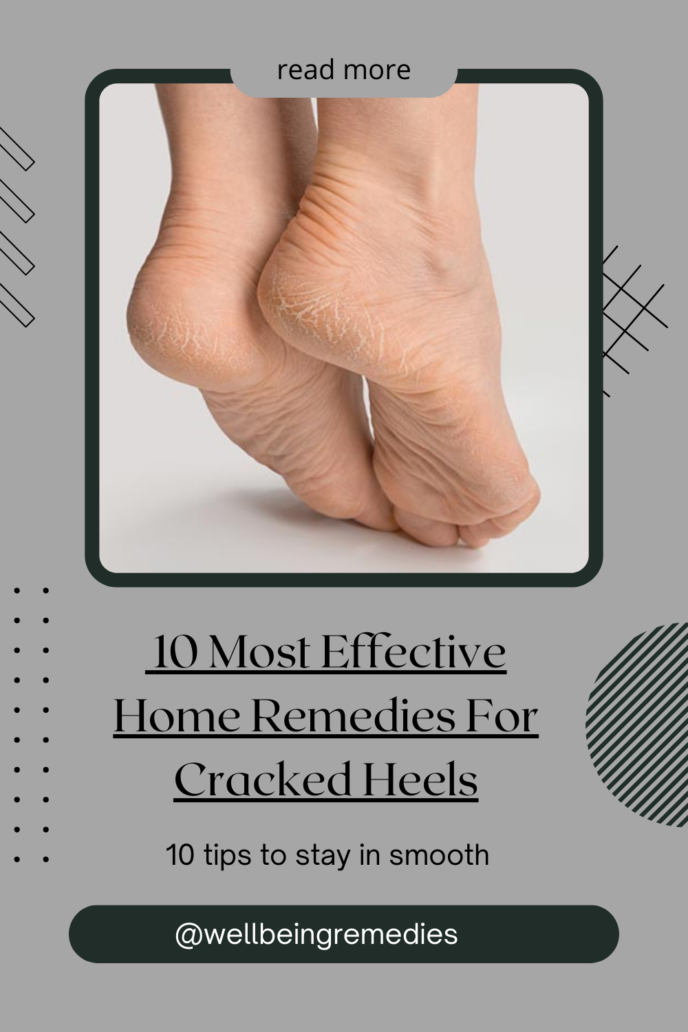 10 Most Effective Home Remedies For Cracked Heels
