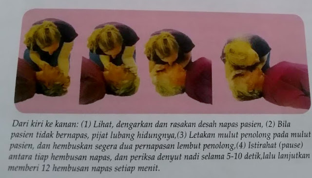 cara memberikan pernapasan buatan (breathing) / mouth to mouth technique