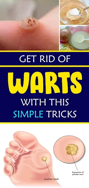 The Easiest Way to Get Rid of Warts Naturally