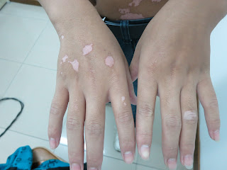 Vitiligo On Hand ,Finger,Back and Palms