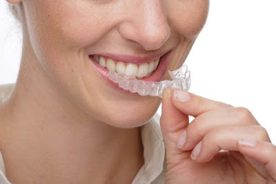  Tẩy trắng răng bằng máng có hiệu quả cao không?