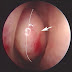 Cas clinique: Concha bullosa et Maux de tête