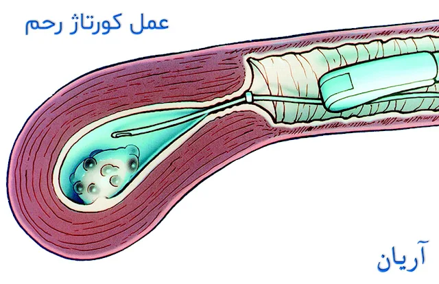 کورتاژ رحم