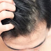 28 Cara Menghilangkan Kutu Rambut dan Telurnya (Metode Alami & Modern)