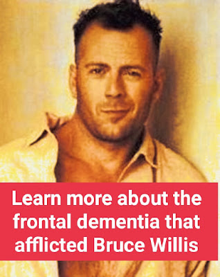 Behind the Spotlight Bruce Willis Brave Battle with Frontotemporal Dementia Learn more about frontal dementia