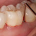 Vì sao chân răng sâu bị sưng cần điều trị ngay?