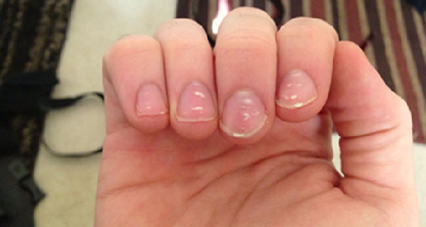 White spots on fingernails are not as uncommon