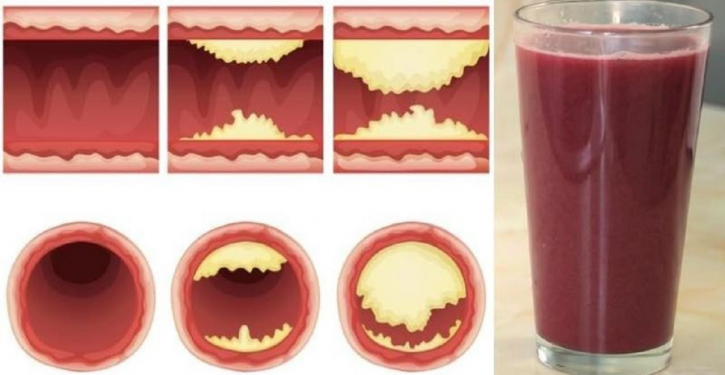 This Delicious Juice Opens Your Arteries And Prevents Heart Disease