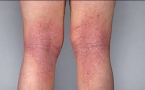 Berapa Harga Obat Eksim Bersih Darah Di Batam Kepulauan Riau Berapa Harga Obat Eksim Bersih Darah Di Batam Kepulauan Riau