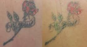 http://obattattoo.blogspot.com/2015/06/hasil-dari-obat-penghilang-tatto.html