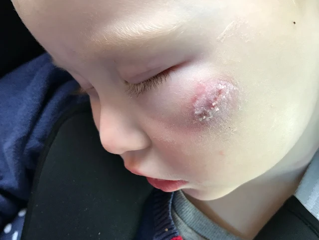 A toddler sleeping in her car seat with a close up on glue freshly applied to a cut on her face