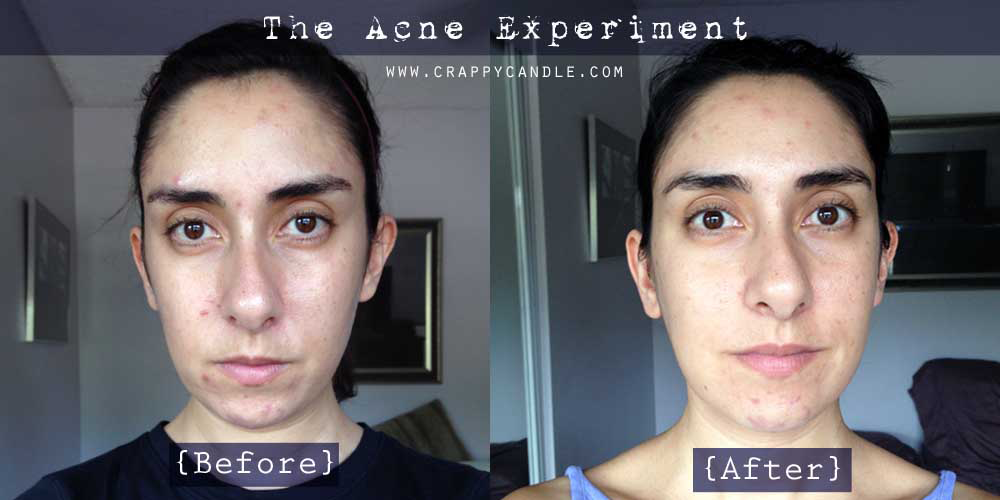 I Didn T Wash My Face For A Month The Acne Experiment Crappy Candle
