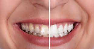 Teeth whitening Miami Beach