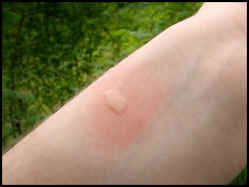 People often mistake bites from other pests as bedbug bites, and end ...