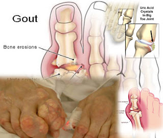 Gejala Asam Urat dan Pengobatannya