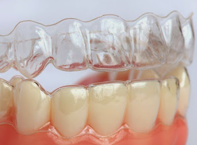 Phương pháp niềng răng không mắc cài 3D Clear