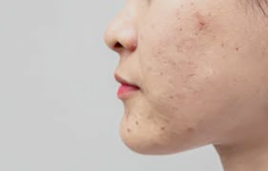 Acne and its treatment